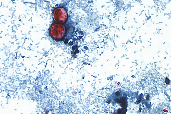 Michigan Reports First Two U.S. Deaths Related To Cyclospora Outbreak