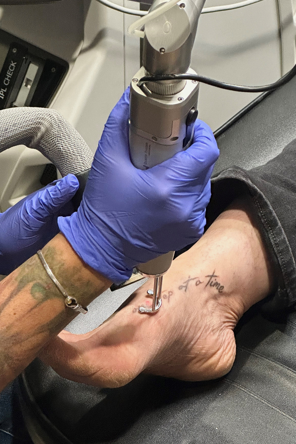 Industry Professionals: Tattoo Removal Costly & Painful