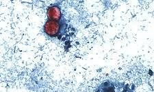 CDC:  15 States Now Linked to Cyclospora Outbreak