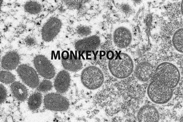 First Probable Monkeypox Case Identified In Livingston County