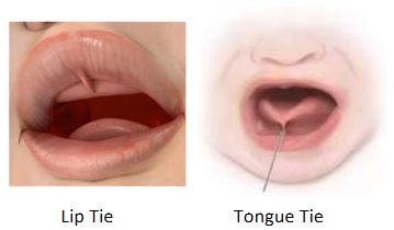 Tongue & Lip Ties Highlighted In Children's Oral Health Series