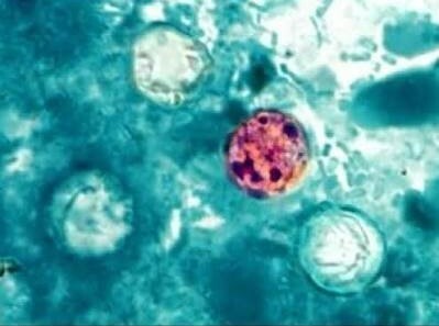 MDHHS Issues Recommendations Amid Growing Cyclosporiasis Outbreak