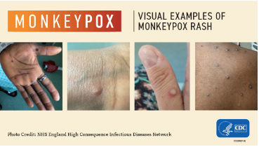 First Probable Monkeypox Case Identified In Livingston County