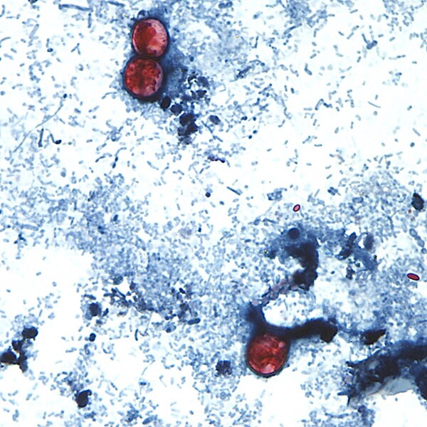 As Cyclospora Illnesses Surge, Michigan Officials Eye Lettuce as Possible Cause